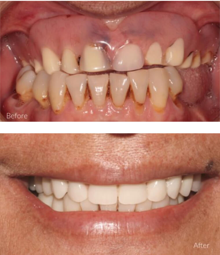 All On 4 Plus | Complete Dental Implants Perth