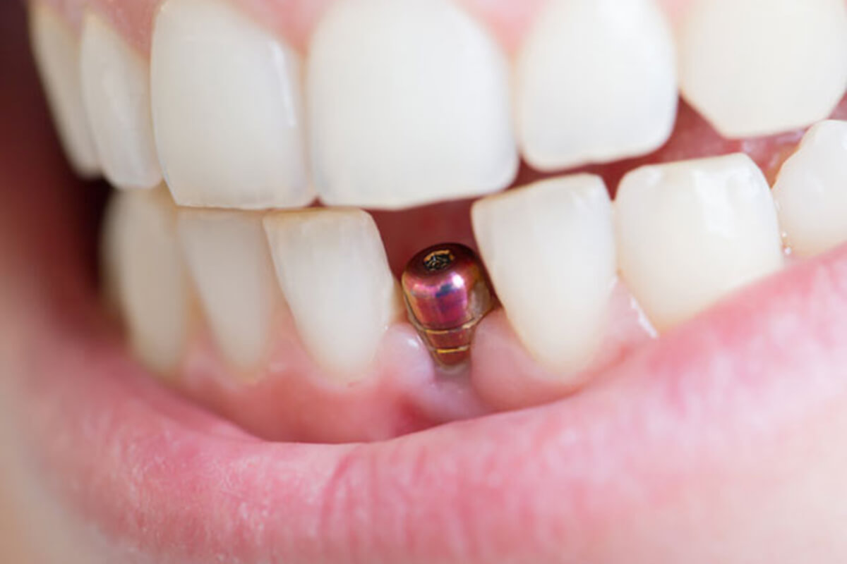 Denture problems | Complete Dental Implants Perth