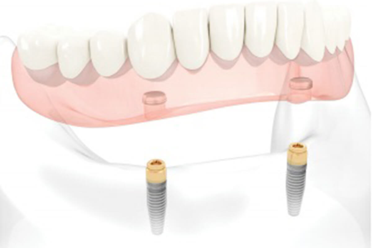 Denture stabilisation | Complete Dental Implants Perth