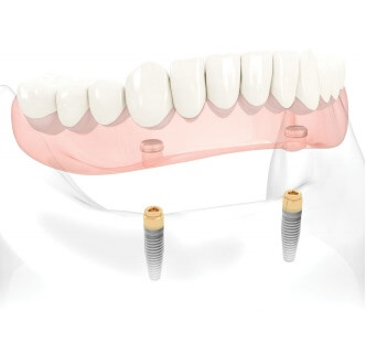 Denture stabilisation - Complete Dental Implants Perth