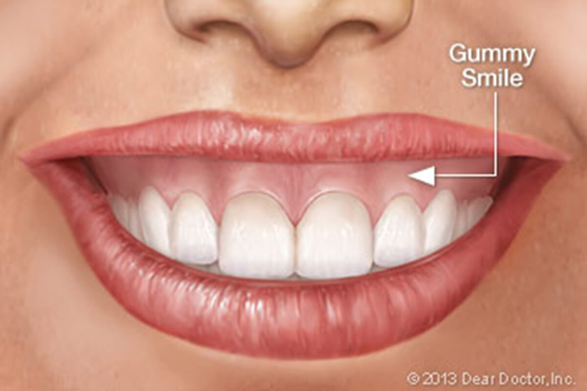 Gummy smile treatment | Complete Dental Implants Perth