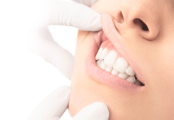 Receded gums - Complete Dental Implants Perth