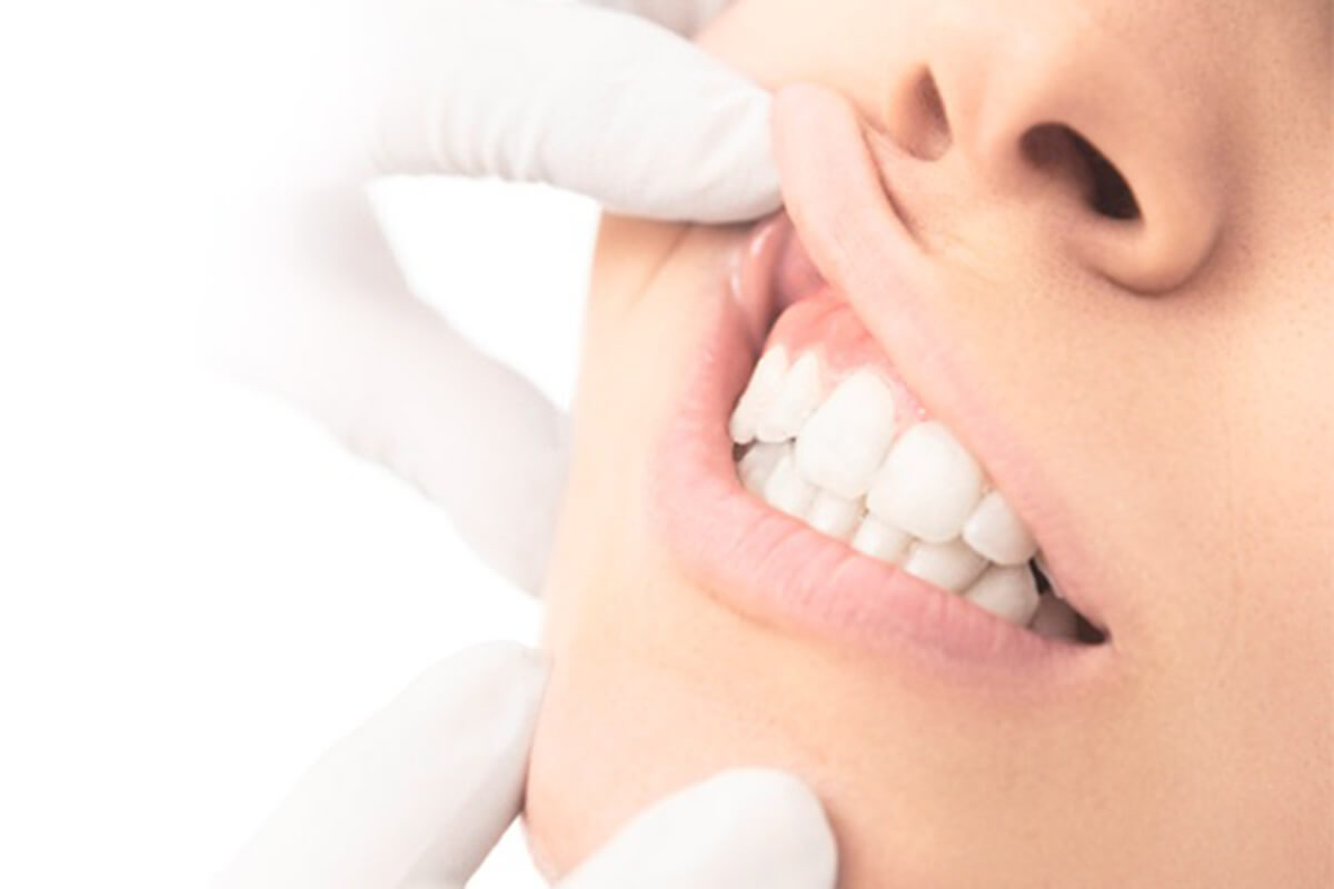 Receded gums | Complete Dental Implants Perth