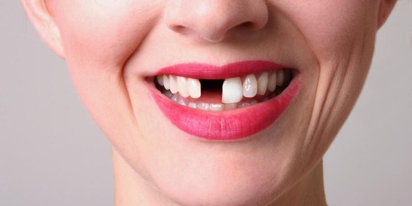 Single tooth replacement | Complete Dental Implants Perth