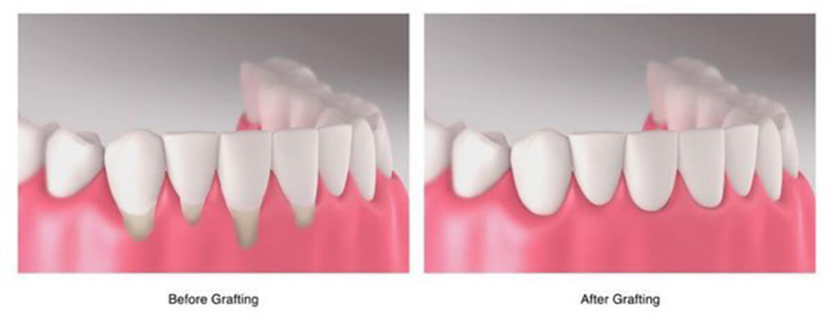 Gum graft | Complete Dental Implants Perth