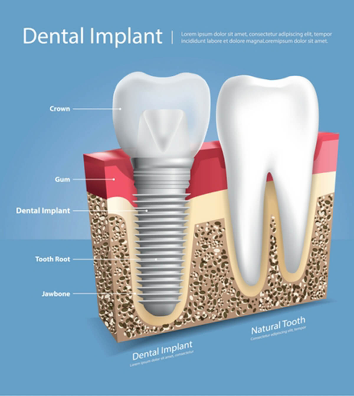 Implant solutions | Complete Dental Implants Perth