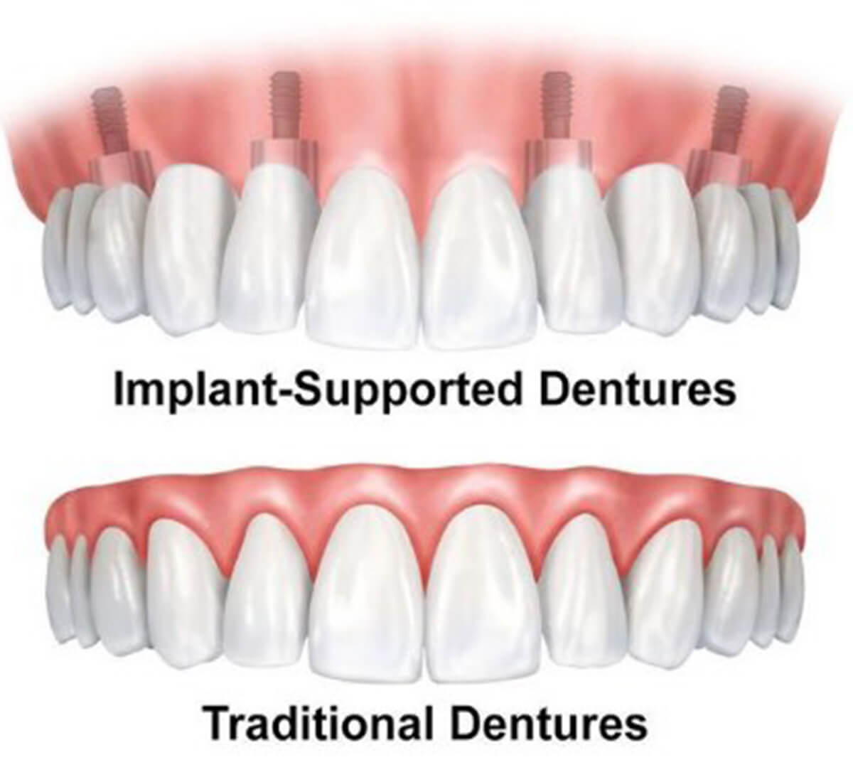 Implant dentures | Complete Dental Implants Perth
