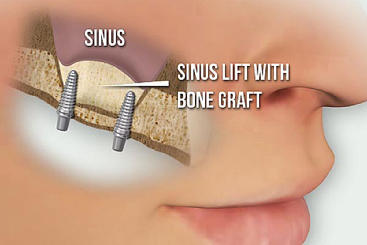 Sinus lift | Complete Dental Implants Perth