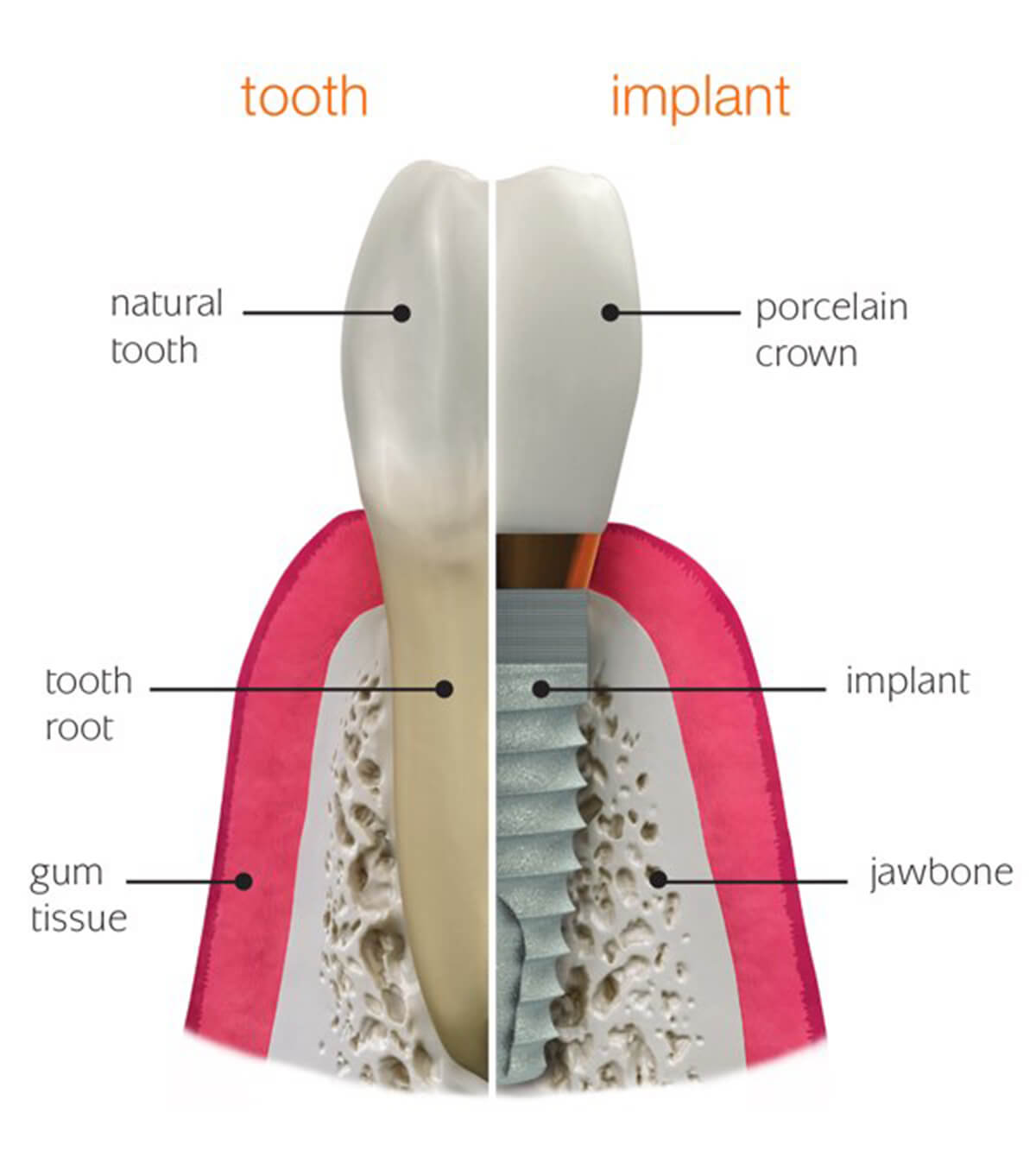 Teeth replacement | Complete Dental Implants Perth