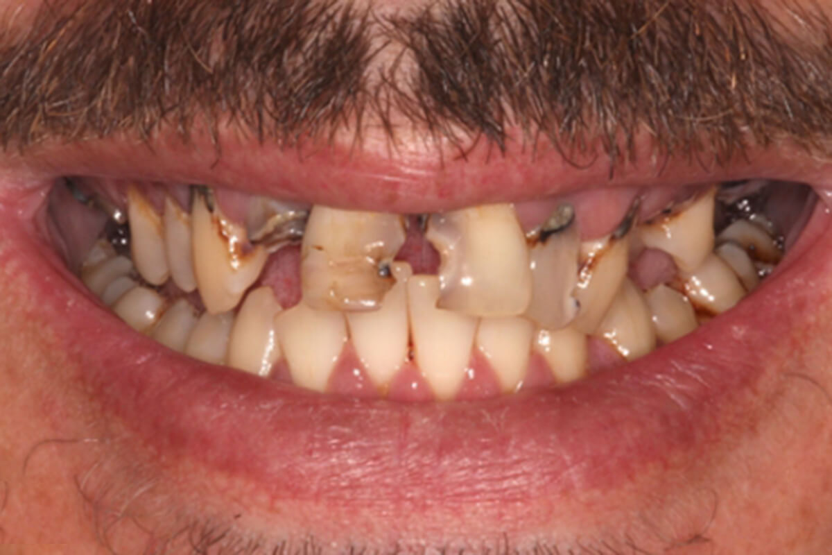 Terminal teeth | Complete Dental Implants Perth