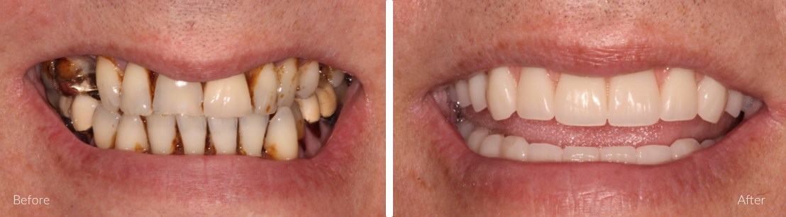 Full teeth replacement for infected and diseased teeth - All On 4 Plus