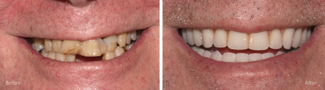 Full teeth replacement for infected and diseased teeth - All On 4 Plus