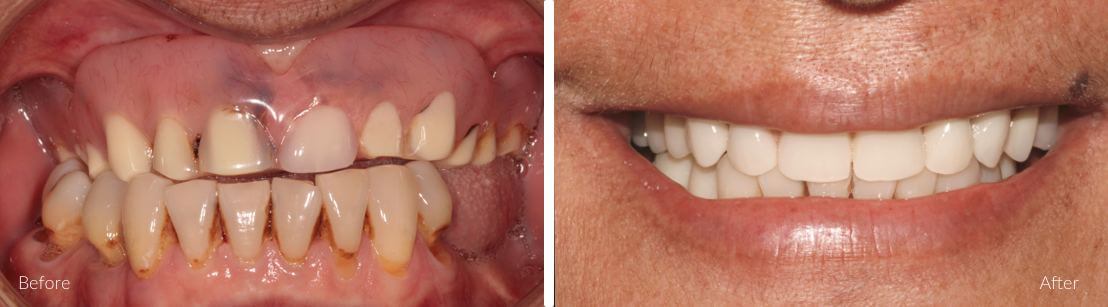 Full teeth replacement for missing teeth & dentures - All On 4 Plus