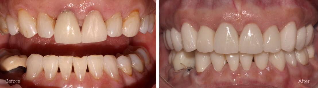 Cosmetic & reconstructive dentistry | Complete Dental Implants Perth
