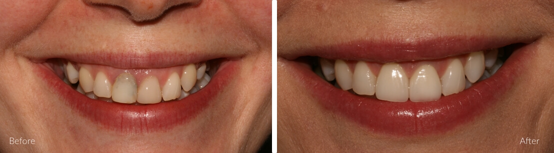 Implants for single & multiple teeth | Complete Dental Implants Perth