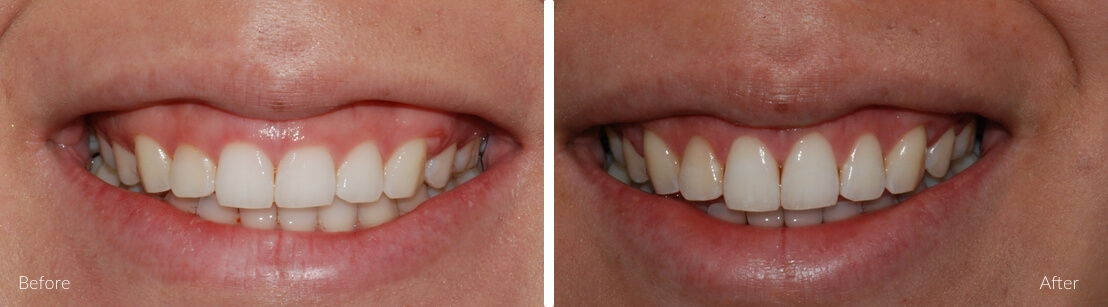 Implants for single & multiple teeth | Complete Dental Implants Perth